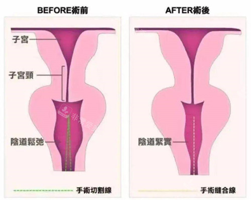 陰道緊縮手術(shù)前后對比動畫演示圖 陰道緊縮手術(shù)前后對比動畫演示圖
