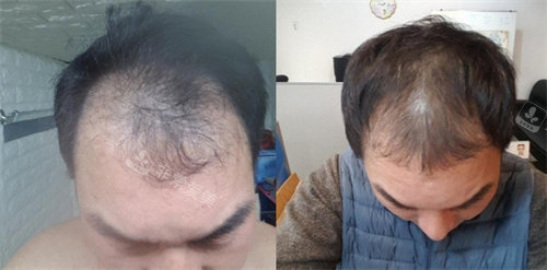 毛發(fā)生長注射2 毛發(fā)生長注射2