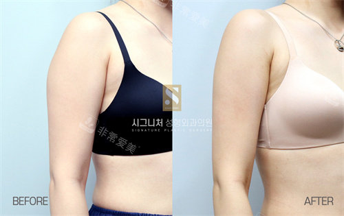 韓國(guó)Signature整形手臂吸脂前后對(duì)比圖