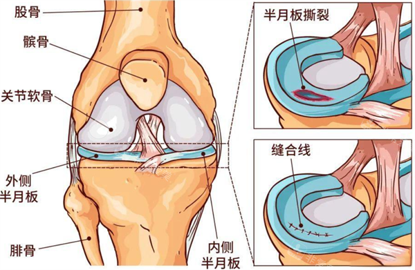 半月板位置及修復(fù)圖示