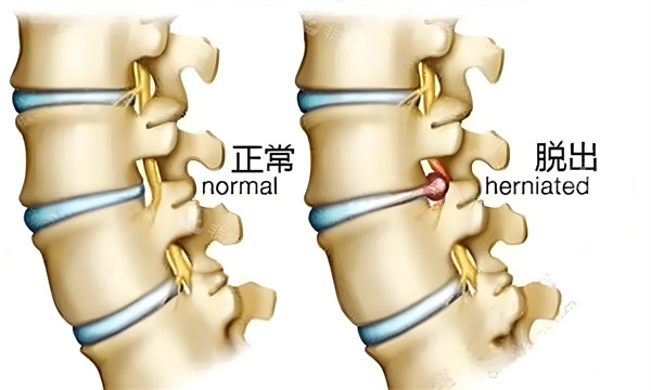 正常腰椎跟脱出腰椎对比图