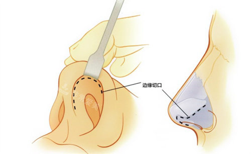 隆鼻手術(shù)的切口 隆鼻手術(shù)的切口