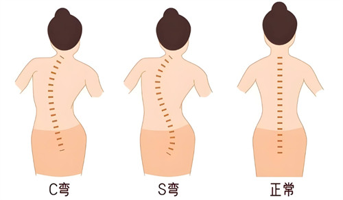 不同類型的脊柱側(cè)彎