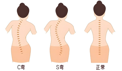 韩国治疗脊柱侧弯好的医院是哪家?李承哲神经外科强推!技术口碑服务都好!