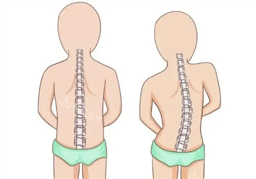 正常脊柱和脊柱側(cè)彎