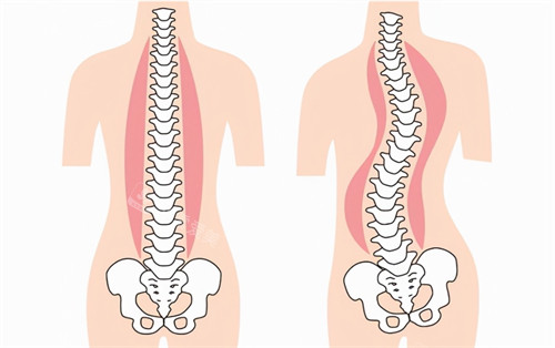 正常的脊柱和侧弯的脊柱