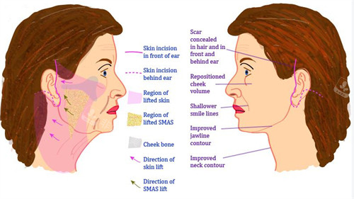 面部提升手术对比图