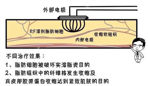 溶脂原理