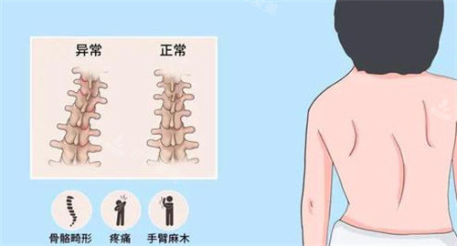 脊柱側(cè)彎 脊柱側(cè)彎