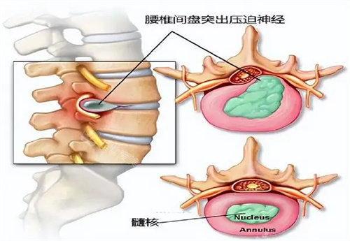 腰椎間盤突出 腰椎間盤突出