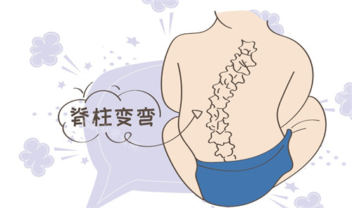 脊柱側(cè)彎
