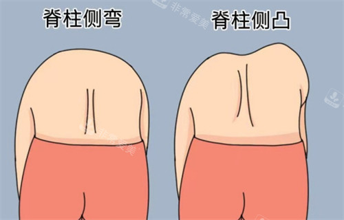 脊柱側(cè)彎和脊柱側(cè)凸