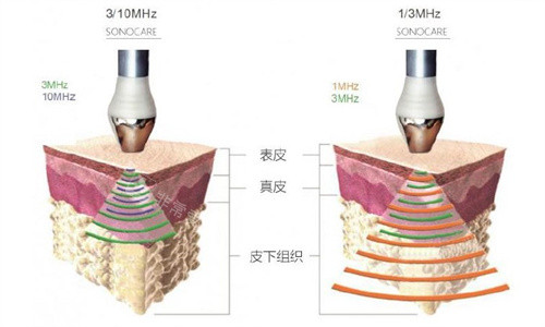 onda是什么医美项目？可以溶脂+提升！我去韩国体验了一把真的被惊艳到了