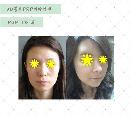 PRP 脂肪移植前后照片 PRP 脂肪移植前后照片