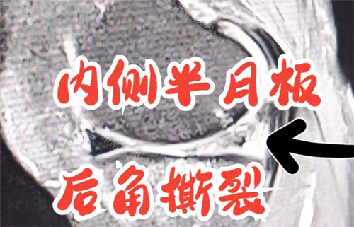 1731901226380622.jpg 半月板撕裂照片.jpg