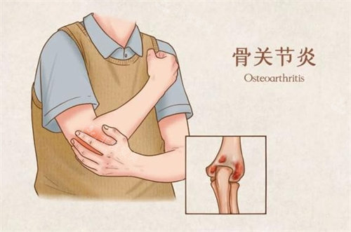 骨关节炎