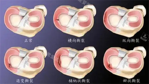 半月板损伤图片