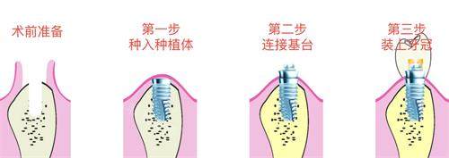 种植牙的步骤