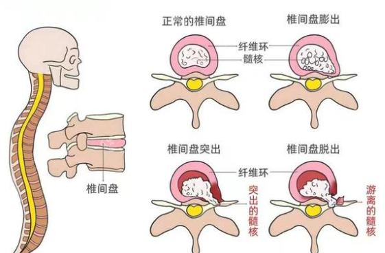 腰间盘突出细节 腰间盘突出细节