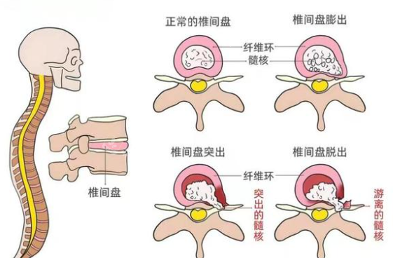 腰间盘突出细节