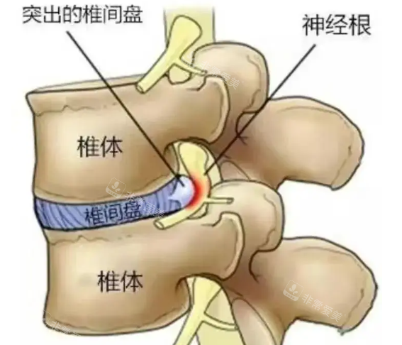 腰间盘突出骨骼剖析图 腰间盘突出骨骼剖析图