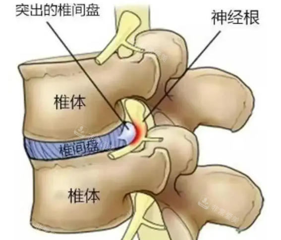 腰间盘突出骨骼剖析图