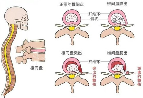 去韩国做了腰椎间盘突出手术，医生技术靠谱术后改善的特别好！