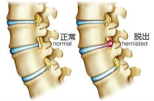 腰椎间盘突出