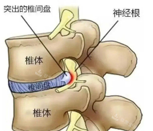 腰椎间盘突出骨头模拟细节图.jpg