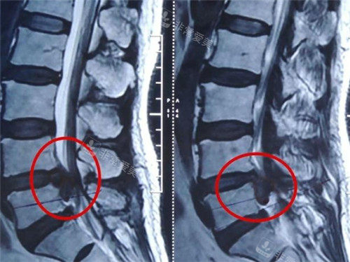 腰椎间盘突出细节示意图.jpg
