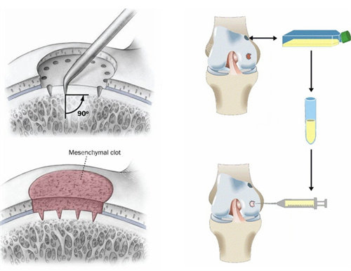 关节炎干细胞治疗流程图