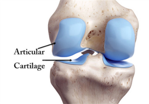 膝盖软骨磨损