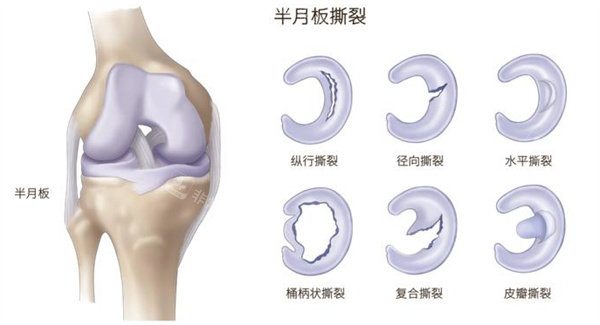 半月板損傷撕裂 半月板損傷撕裂