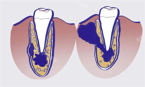 牙齿根尖囊肿