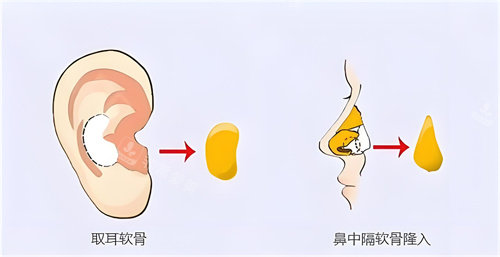隆鼻耳軟骨 隆鼻耳軟骨