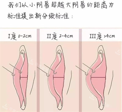 陰唇肥大分級(jí)演示動(dòng)畫(huà)圖