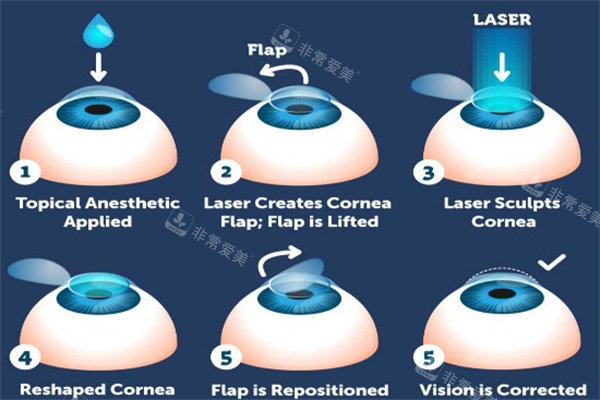 激光治疗近视眼动画图