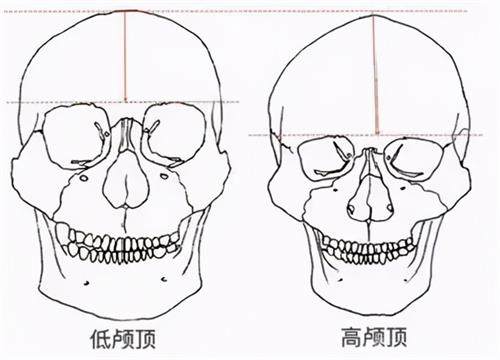 我去韩国做了颅顶骨水泥填充手术,价格是605W韩币,术后颅顶高了2cm,很满意!