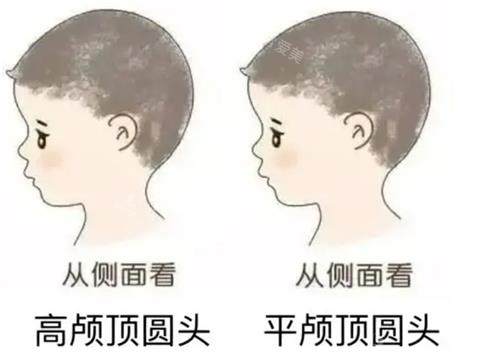 高顱頂和正常頭的對比