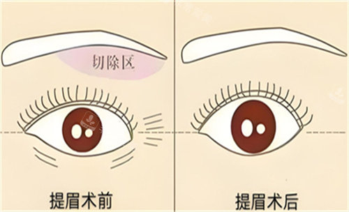 提眉手術(shù)前后對(duì)比 提眉手術(shù)前后對(duì)比
