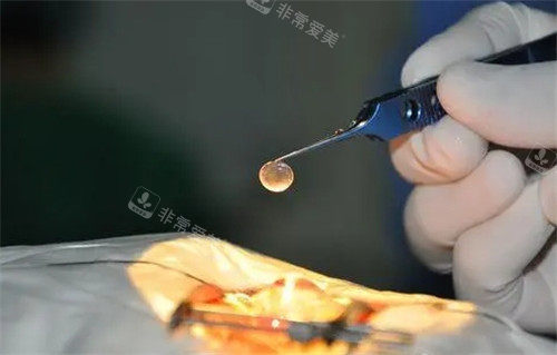 角膜移植手术细节图