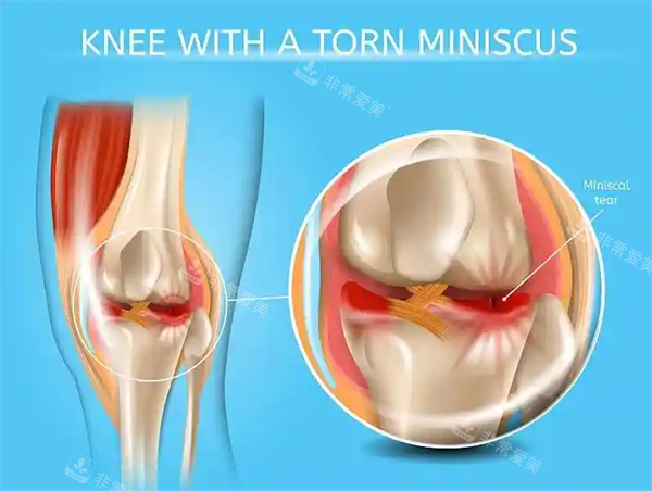 半月板损伤展示图
