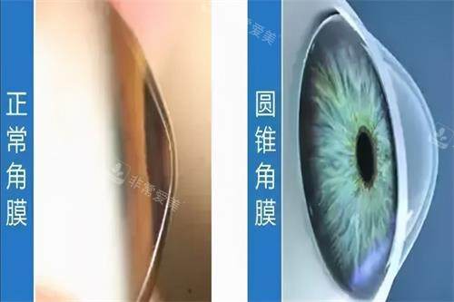 圆锥角膜和正常角膜的区别