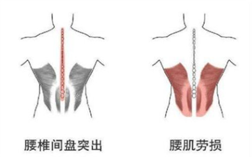 腰肌劳损造成的变化