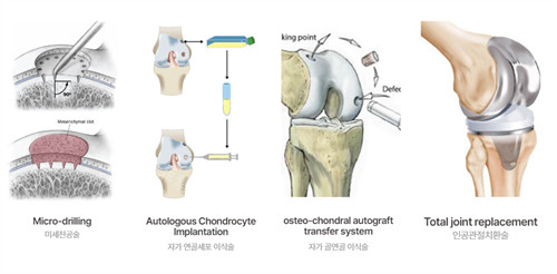 韩国综合医院治疗关节疼痛哪家好?NANOORI医院的干细胞疗法速看下~