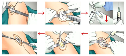 干细胞疗法手术过程