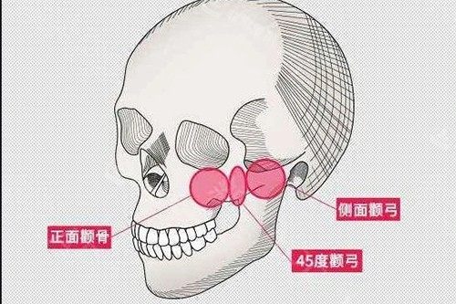 顴骨顴弓大概位置示意圖 顴骨顴弓大概位置示意圖