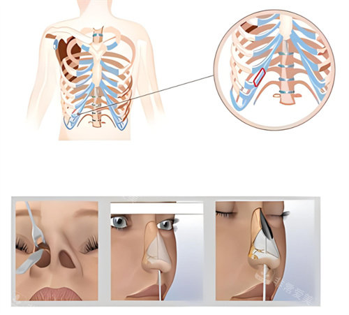 隆鼻肋骨鼻原理圖