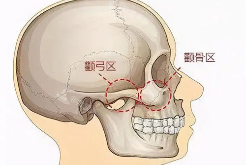 顴弓顴骨位置示意圖 顴弓顴骨位置示意圖