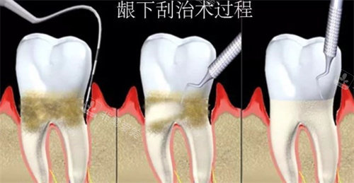 龈下刮治过程